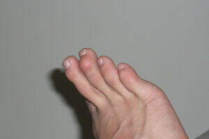 How to Stop Toes From Curling: Exercises and Footwear Fixes